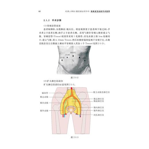 机器人辅助/腹腔镜泌尿外科高难度及创新手术荟萃(精)/国际医学研究前沿/张大宏/浙江大学出版社/专著/有视频二维码 商品图5