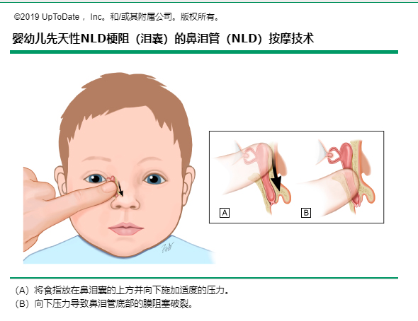 宝宝总是眼泪汪汪，当心鼻泪管堵塞
