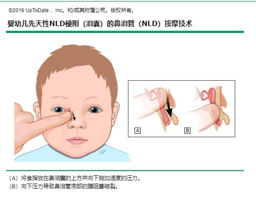 宝宝总是眼泪汪汪，当心鼻泪管堵塞 商品图0