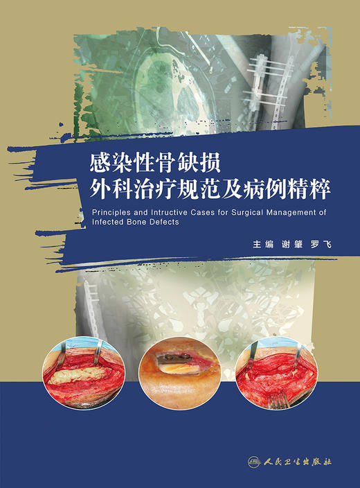 感染性骨缺损外科zhi疗规范及病例精粹 2022年6月参考书 9787117331210 商品图1
