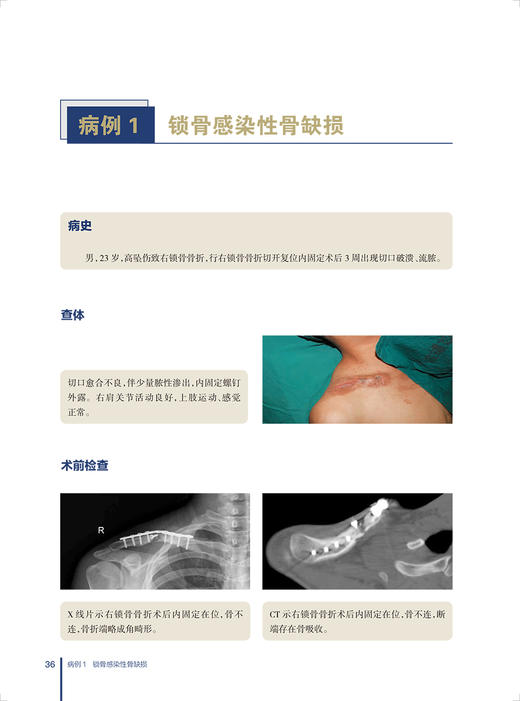 感染性骨缺损外科治疗规范及病例精粹 谢肇 罗飞 临床诊断治疗理念术前评估术前计划病例图谱 人民卫生出版社9787117331210 商品图4
