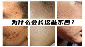 闭口，一个像痘痘一样让人烦的家伙！