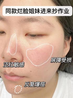 不想敏感肌姐妹反复走弯路！褪红修护我只服它！