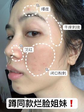 脸红！烂脸！敏感肌自救实录❗