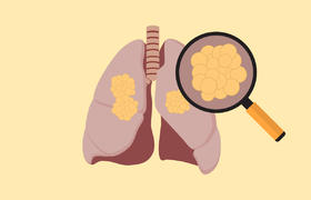  肺癌早筛方式：低剂量螺旋CT+肺癌七种自身抗体联合筛查 