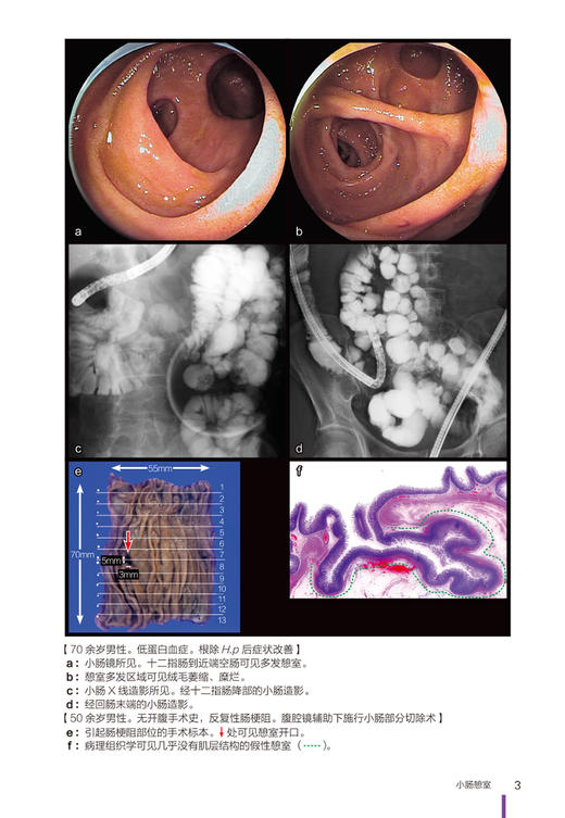 下消化道内镜诊断图谱 谢威 祝建红 译 消化道内镜操作注意事项中初级内镜医生参考书外科 辽宁科学技术出版社9787559123510 商品图3
