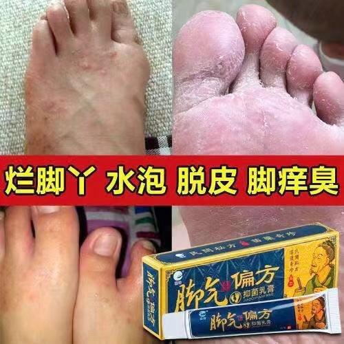 麓神 苗方脚臭偏方草本乳脚痒脚臭脱皮烂脚水泡烂脚丫15g/支 商品图1