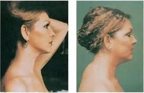  脖子粗，肩膀宽，胸背厚，不是胖！是淋巴堵了！你该做肩颈疏通了 