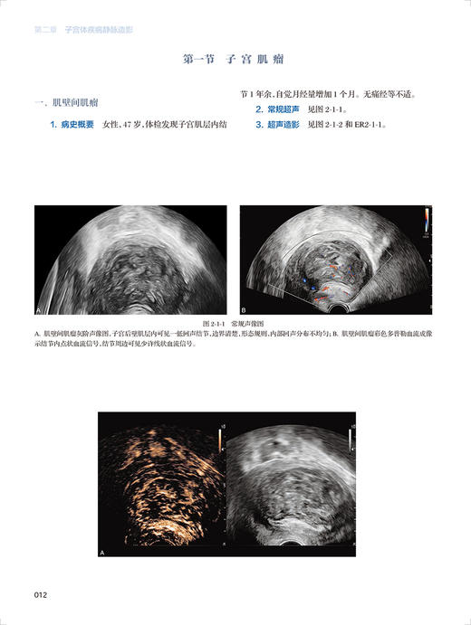 妇产超声造影图鉴 中国医师协会超声医师分会超声造影图鉴丛书 聂芳 谢红宁 妇科临床造影病例 人民卫生出版社9787117330602 商品图4