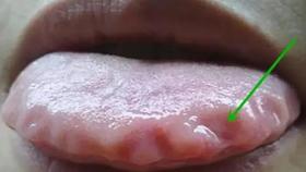  齿痕舌多气虚，三伏天这样做祛湿补气 