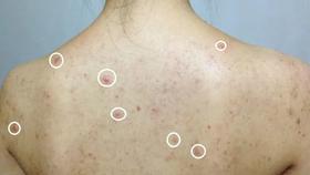  背后长了很多的“小米粒”，教你一招排湿祛毒！ 