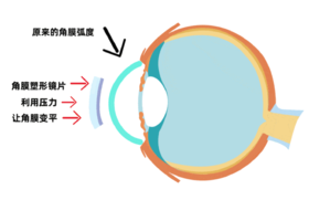 OK镜真的能拯救孩子的近视吗？