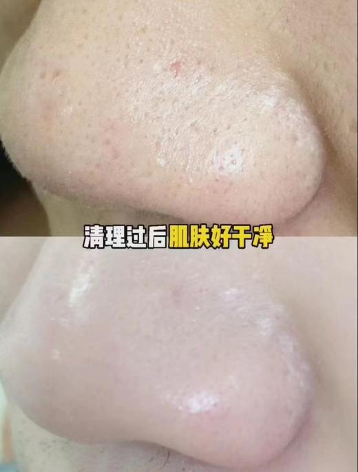 【限时折扣】不锈钢粉刺针8件套装(塑料盒) 商品图3