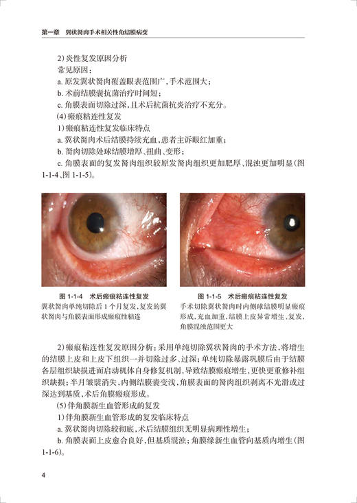 眼科手术相关性角结膜病变眼表疾病临床系列 白内障 青光眼手术相关性角结膜病变 贾卉 孙旭光编9787117331203人民卫生出版社 商品图4