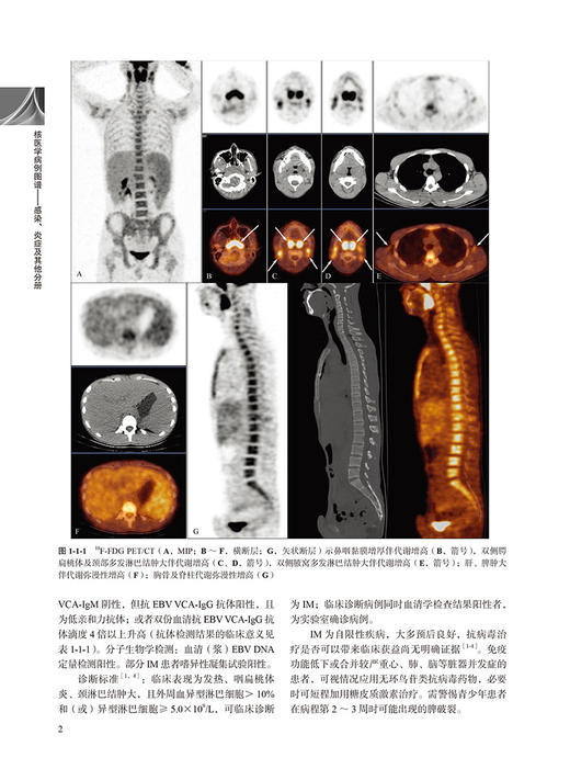 核医学病例图谱 感染炎症及其他分册 付占立 何作祥主编 核医学病案分析图谱 9787565926303北京大学医学出版社 商品图4