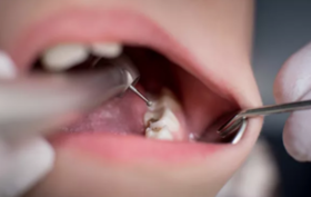  宝贝牙齿表面粗糙、有白斑一定要警惕！别等牙黑了才后悔！ 