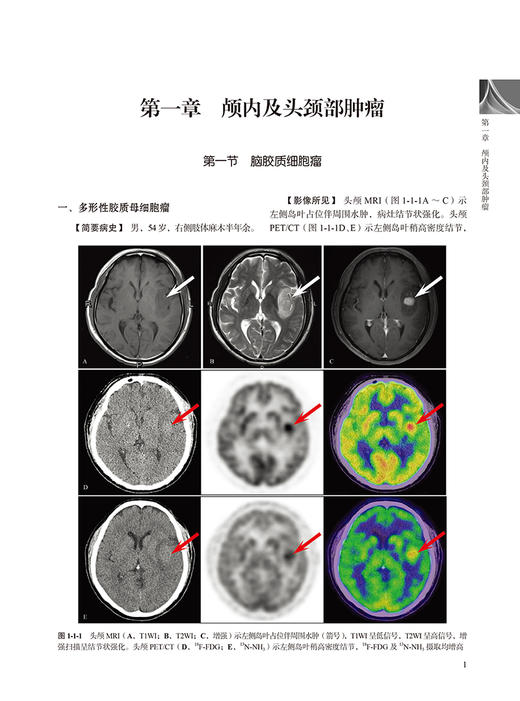 核医学病例图谱 肿瘤分册 付占立 何作祥 主编 核医学肿瘤病案分析图谱汇编 PET/CT影像诊断临床 北京大学医学出版社9787565926273 商品图4