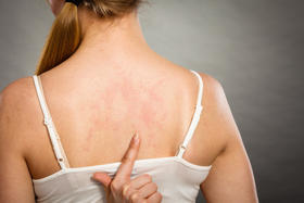 常感身体痒，可能是螨虫在作祟！