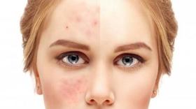  秋季皮肤干燥起皮怎么办？