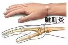  疼！“手机控”、“带娃党”必看！艾灸调理腱鞘炎复发率低！ 