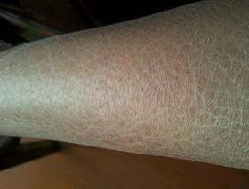  腿部干痒难耐，脚后跟干裂疼痛，多半肾气不足！常艾灸“补水止痒穴”滋润皮肤！ 