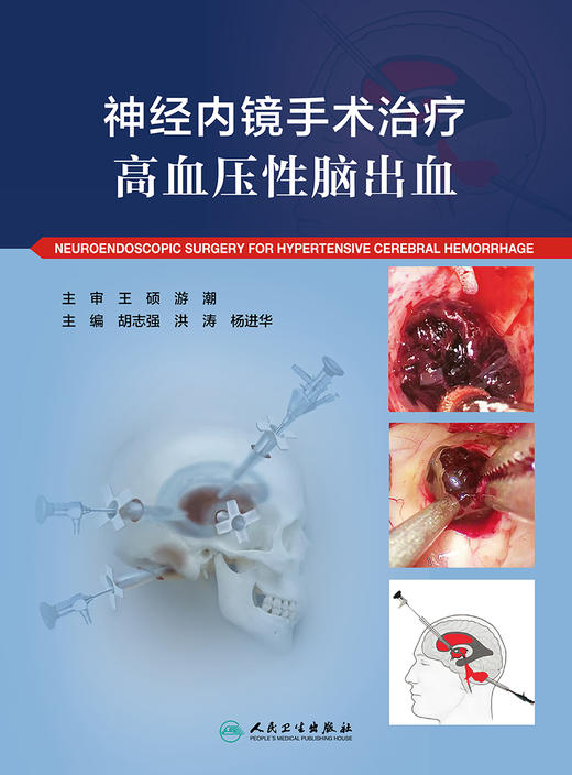 神经内镜手术zhi疗高血压性脑出血 2022年9月参考书 9787117332996 商品图1