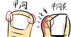  甲沟炎是“剪出来的”？看看怎么给它灸回去 