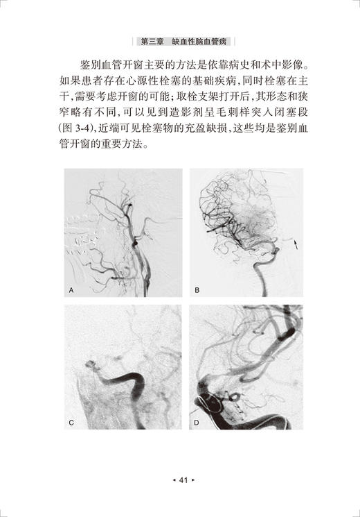 脑卒中介入治疗 脑卒中防治系列丛书 刘建民缪中荣 提升脑卒中筛查与干预质量探索慢性病防治模式 人民卫生出版社9787117328357 商品图4