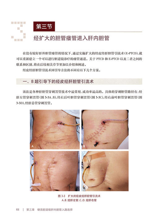 现货 硬质胆道镜微创技术 刘安重著 肝胆解剖影像技术腔镜开腹手术特点 内窥镜胆道疾病显微外科手术 人民卫生出版社9787117331548 商品图4