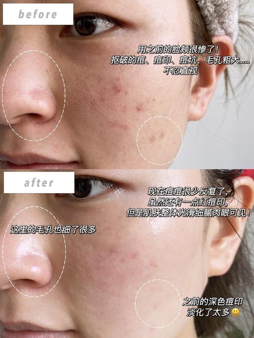 【exp26年6月】嫩滑去闭口！proya珀莱雅多酸复合面膜7ml 商品图5