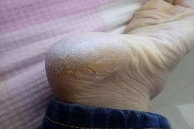  秋冬以后，脚后跟干裂，说明你肾虚；小腿长“鱼鳞“，说明你瘀血！ 