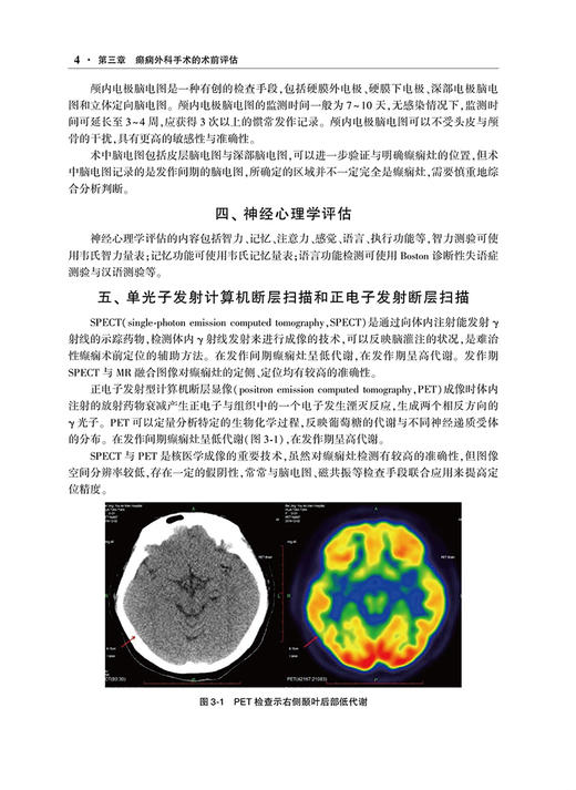 现货 临床技术操作规范 癫痫外科分册 栾国明主编 癫痫神经外科学技术操作规程 脑皮质切除性手术等 人民卫生出版社9787117333771 商品图4