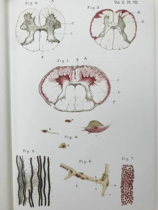 医学经典让-马丁·沙可《神经系统疾病讲座》（全3卷） 约百幅插图 豪华皮装大32开 商品图11