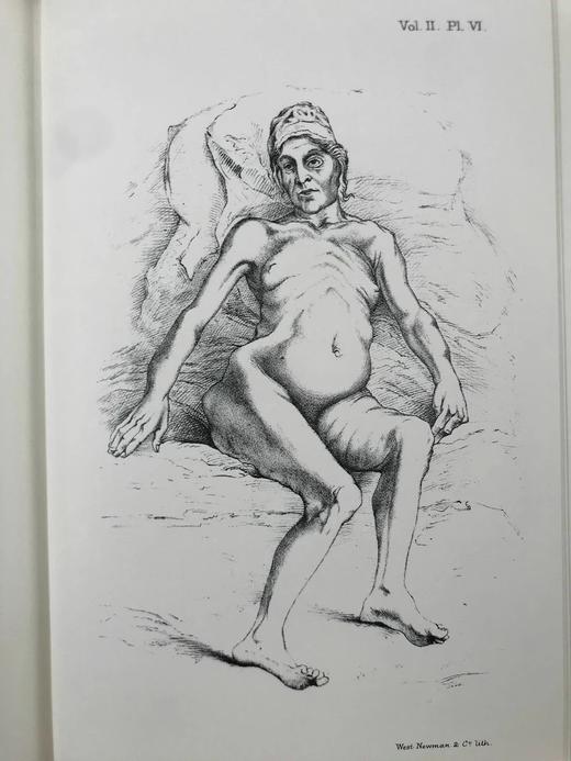 医学经典让-马丁·沙可《神经系统疾病讲座》（全3卷） 约百幅插图 豪华皮装大32开 商品图10