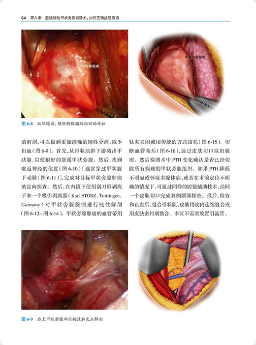正版现货 甲状旁腺手术图谱 韦伟 李朋主译 配临床病例实操视频 治疗原发性甲状旁腺功能亢进手术方式人民卫生出版社9787117333696 商品图4