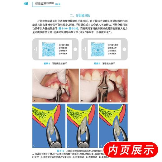 全2册根管治疗图谱第2版+标准拔牙手术图谱第2版 拔牙技巧口腔种植修复颌面外科正畸操作牙体牙髓病根尖周病修复 人民卫生出版社 商品图3