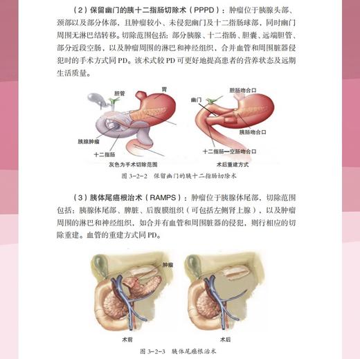 答“胰”解惑——专家谈胰腺癌那些事 商品图2