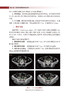 妇科肿瘤 肿瘤精准放射治疗靶区勾画丛书 中国核学会近距离治疗与智慧放疗分会推荐系列教材 王俊杰 人民卫生出版社9787117338509 商品缩略图4