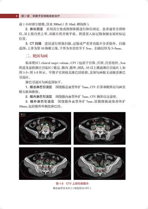 妇科肿瘤 肿瘤精准放射治疗靶区勾画丛书 中国核学会近距离治疗与智慧放疗分会推荐系列教材 王俊杰 人民卫生出版社9787117338509 商品图4