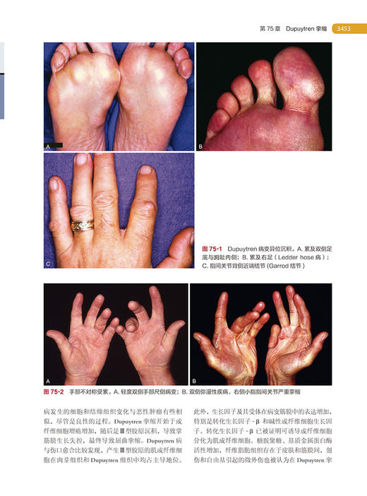 坎贝尔骨科手术学 第14版 第6卷 手外科 唐佩福 卢世璧等译 世界骨科权威经典著作 外科手术技术 北京大学医学出版社9787565925702 商品图3
