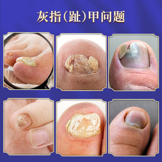 【轻松一滴！白云山灰指甲修护液】轻松一滴，深层渗透，草生yijun，趾甲黑厚水软甲膏足部软甲甲桉液30ML/瓶 商品图1