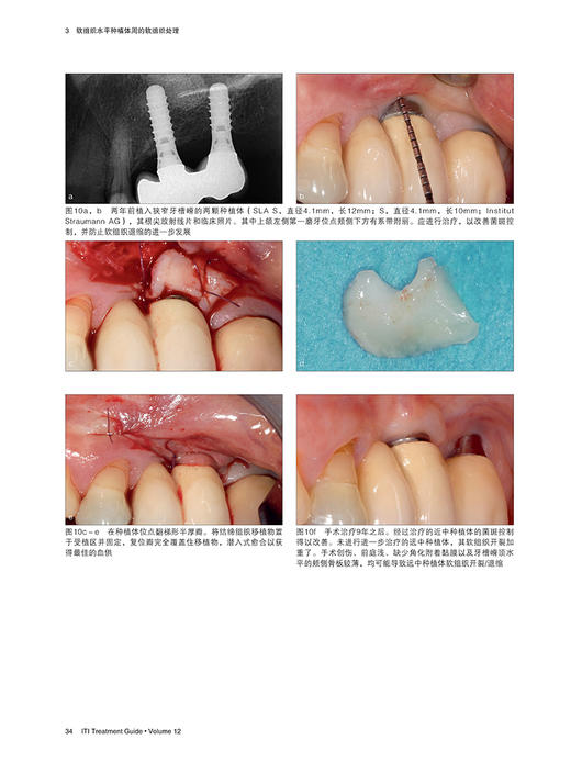 种植体周软组织整合与处理 国际口腔种植学会ITI口腔种植临床指南 第十二12卷中文版 宿玉成主译 辽宁科学技术出版社9787559128393 商品图3