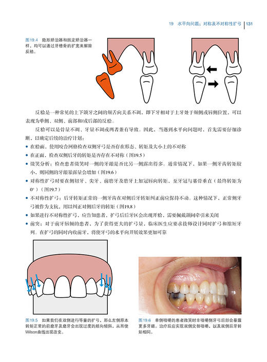 无托槽隐形矫治技术 郭润智 张云帆 黄一平主译 口腔正畸 错牙合畸形临床治疗中隐形矫治器应用 辽宁科学技术出版社9787559126450 商品图3
