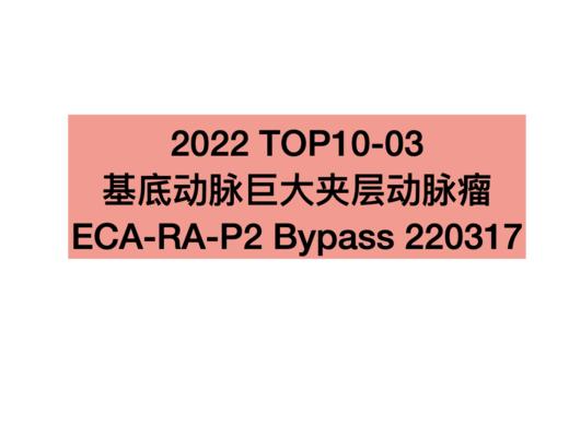 TOP3.基底动脉巨大夹层动脉瘤ECA-RA-P2 Bypass 商品图0