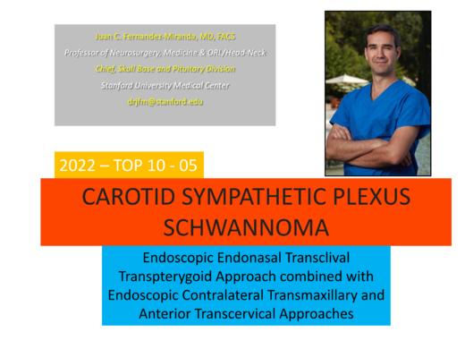 TOP5.颈动脉交感神经丛 神经鞘瘤 商品图0