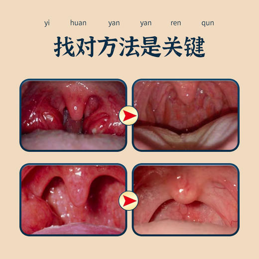 【买2送1 买3送2】九督堂咽炎膏 告别咽部不适 植物成分 轻巧便携 爱吃辛辣人群 粉尘工作人群  杏仁  苏子 枇杷叶 商品图3