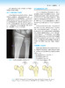 Hoppenfeld骨折治疗与康复 第2版 蔡斌 戴闽 张新涛主译 骨折固定愈合治疗原则技术感染处理康复训练 人民卫生出版社9787117338004 商品缩略图3