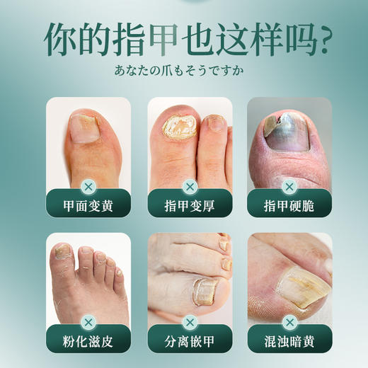 【滋养甲根 远离灰甲】灰甲护理液 亮甲护甲甲沟炎 温润配方温和去灰 灰甲液灰指甲液30ml/盒 商品图1