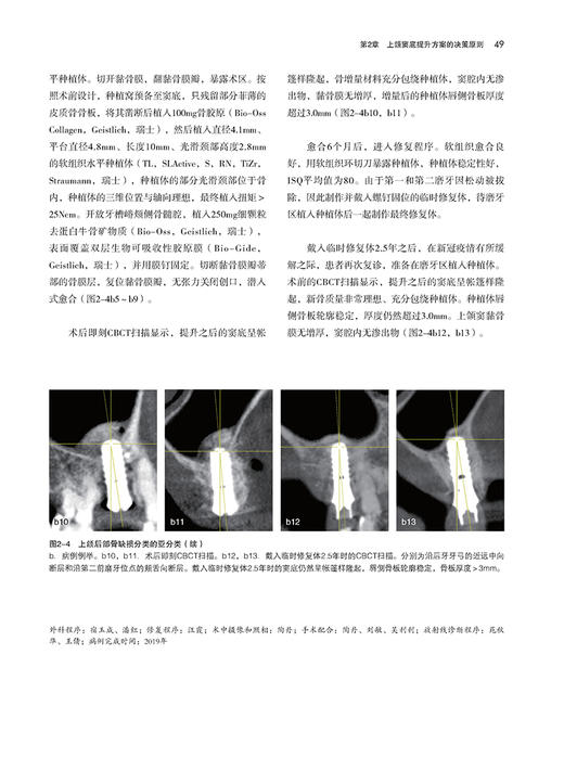 上颌窦底提升 宿玉成主编 口腔种植临床医生上颌窦底提升临床指南 上颌窦应用解剖和放射线诊断 辽宁科学技术出版社9787559127464 商品图4