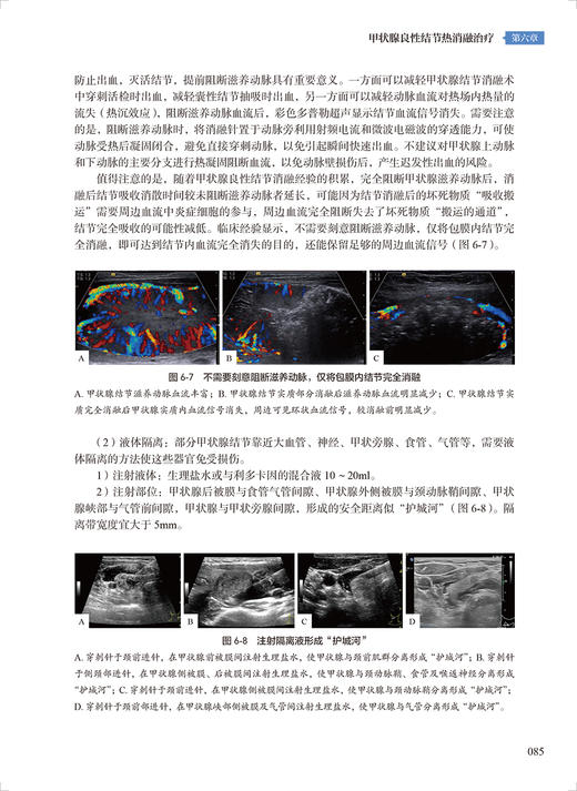 甲状腺与甲状旁腺疾病热消融治疗实战教程 于明安 王淑荣 疾病影像学病理学诊断消融技巧手法指导教材人民卫生出版社9787117341875 商品图4